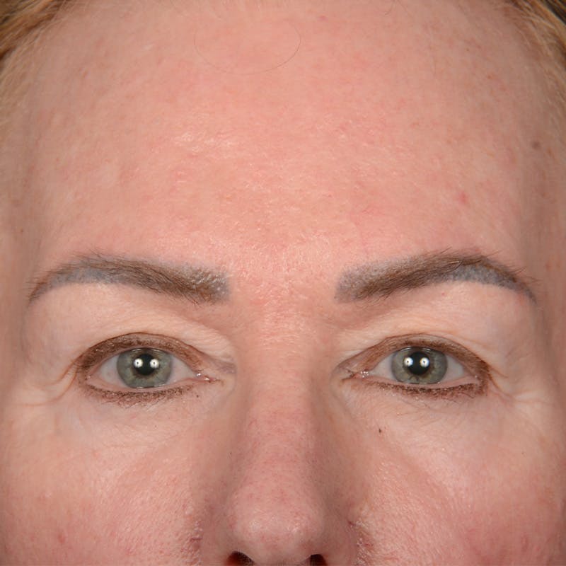 Eyelid Surgery Before & After Gallery - Patient 361513 - Image 1
