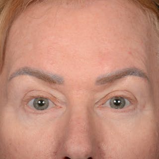 Eyelid Surgery Before & After Gallery - Patient 361513 - Image 2