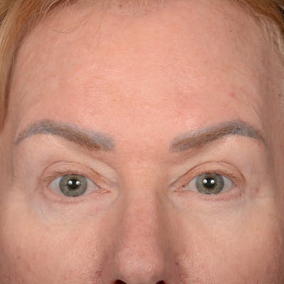 Eyelid Surgery Before & After Gallery - Patient 361513 - Image 2