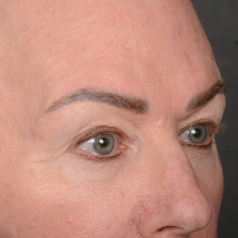 Eyelid Surgery Before & After Gallery - Patient 361513 - Image 3