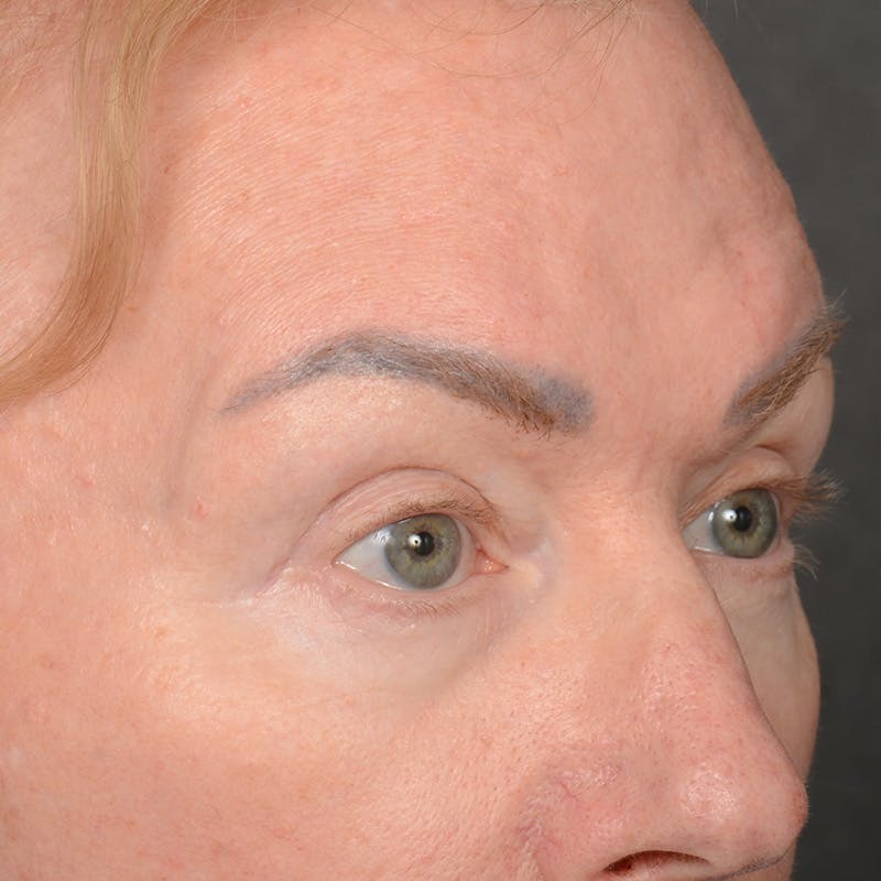Eyelid Surgery Before & After Gallery - Patient 361513 - Image 4