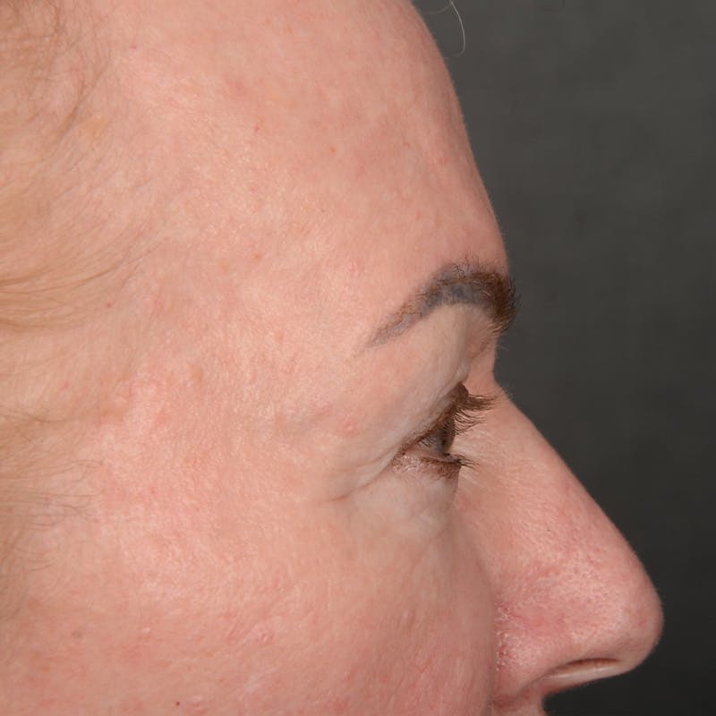 Eyelid Surgery Before & After Gallery - Patient 361513 - Image 5