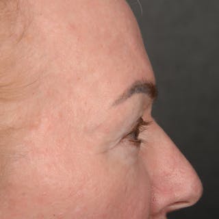 Browlift Before & After Gallery - Patient 752820 - Image 6