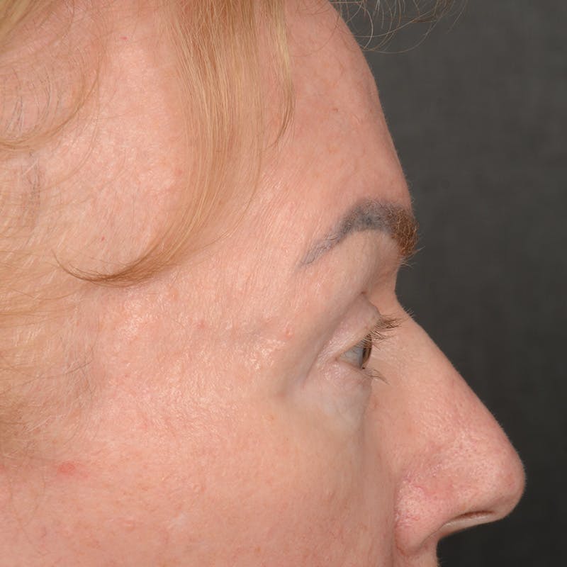 Eyelid Surgery Before & After Gallery - Patient 361513 - Image 6
