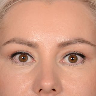 Eyelid Surgery Before & After Gallery - Patient 268826 - Image 2