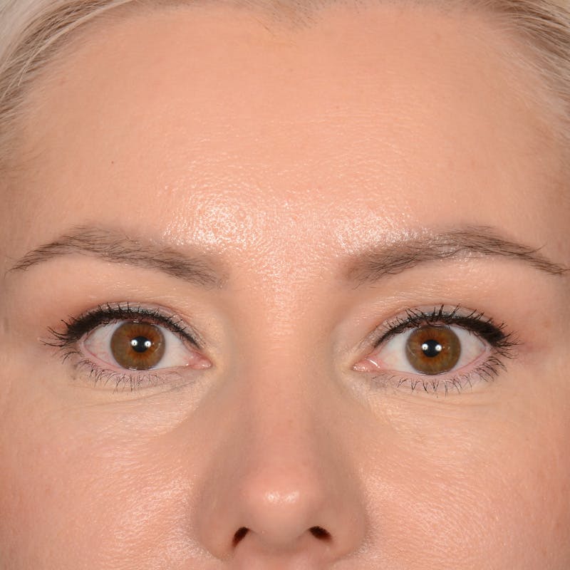Eyelid Surgery Before & After Gallery - Patient 268826 - Image 2