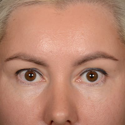 Eyelid Surgery Before & After Gallery - Patient 268826 - Image 1