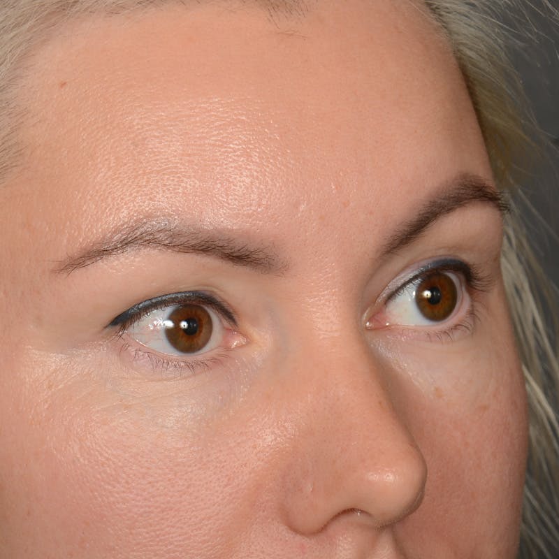 Eyelid Surgery Before & After Gallery - Patient 268826 - Image 3
