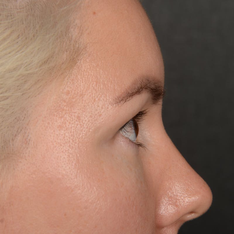 Eyelid Surgery Before & After Gallery - Patient 268826 - Image 5