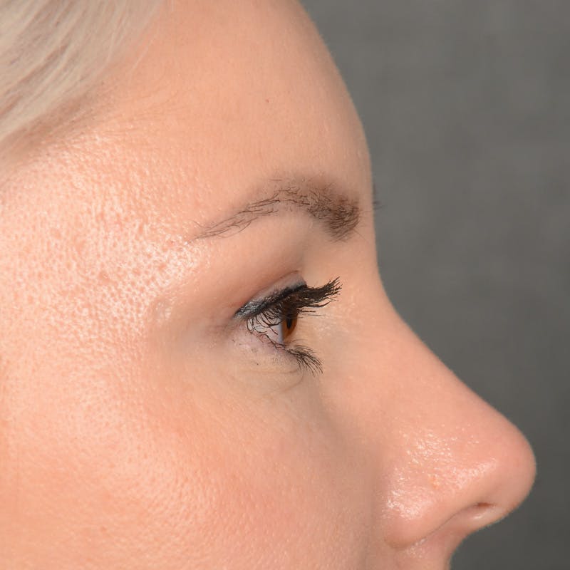 Eyelid Surgery Before & After Gallery - Patient 268826 - Image 6