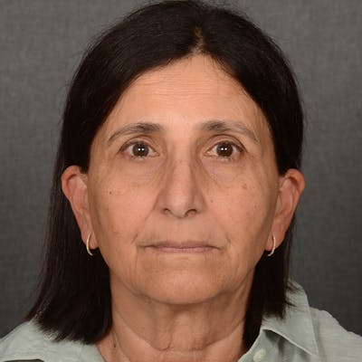 Facelift Before & After Gallery - Patient 682688 - Image 1