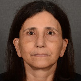 Facelift Before & After Gallery - Patient 682688 - Image 2