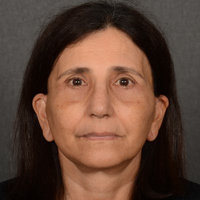 Facelift Before & After Gallery - Patient 682688 - Image 2