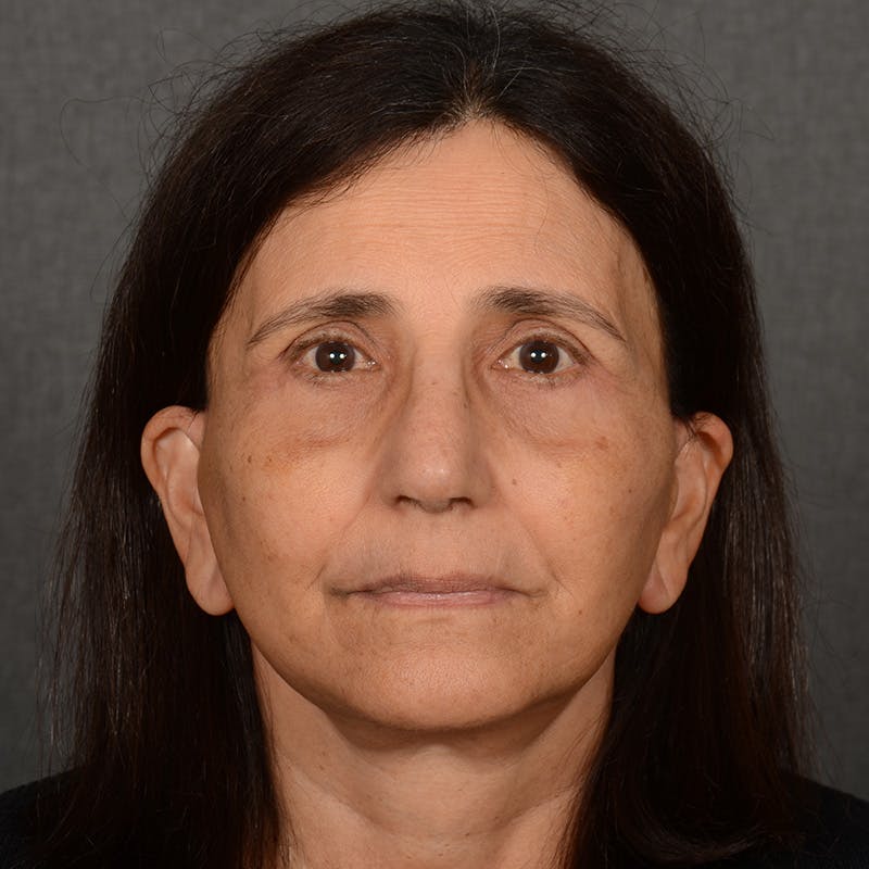 Facelift Before & After Gallery - Patient 682688 - Image 2
