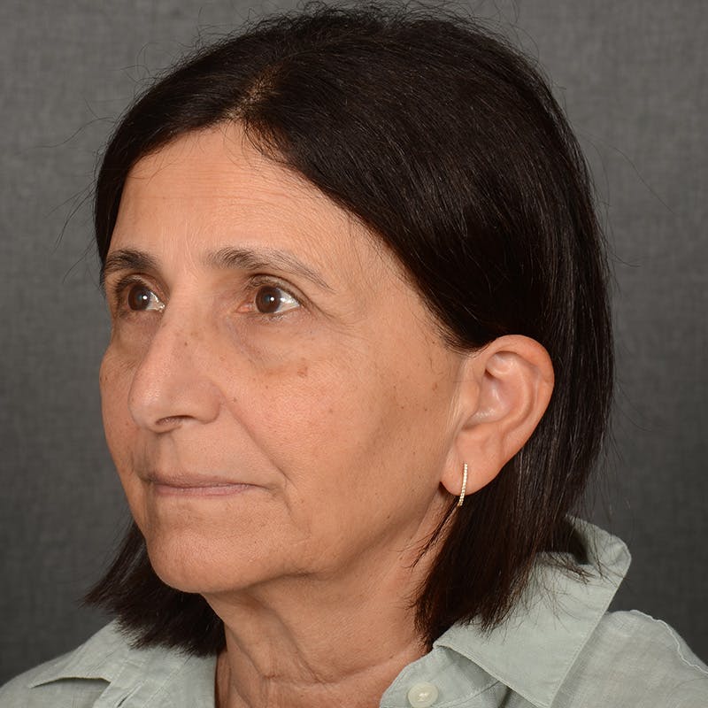 Facelift Before & After Gallery - Patient 682688 - Image 3