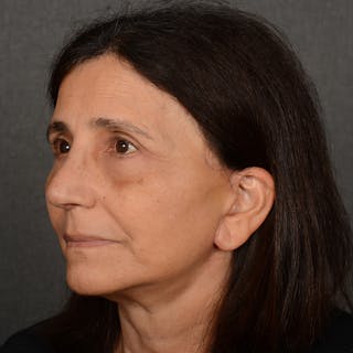 Facelift Before & After Gallery - Patient 682688 - Image 4