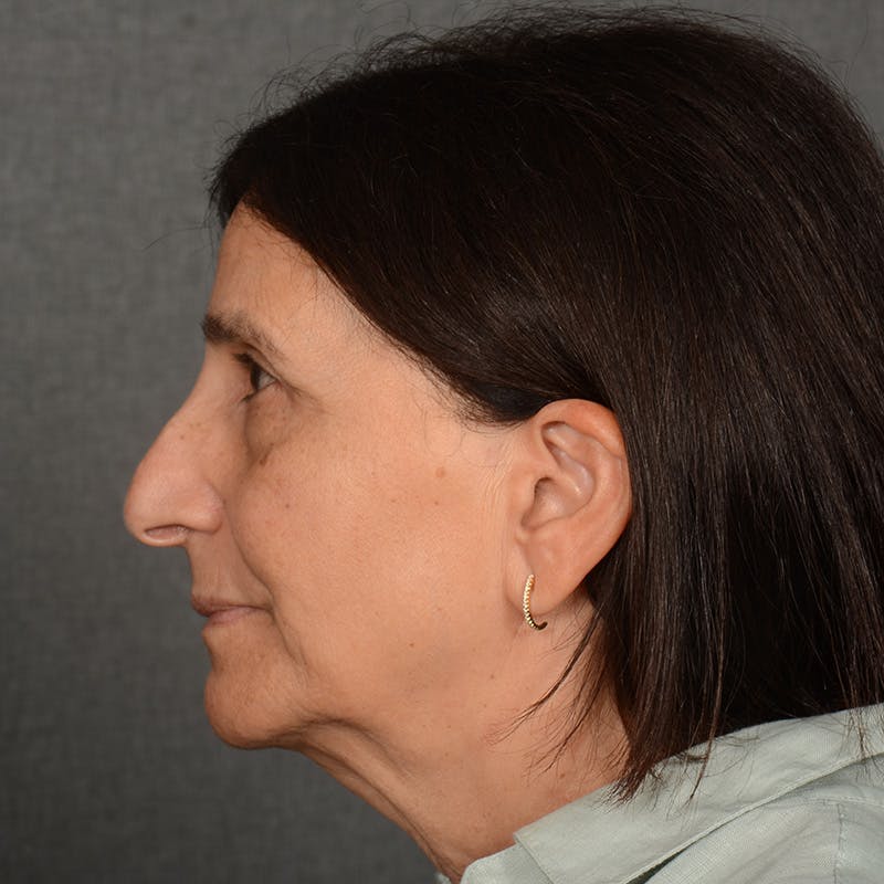 Facelift Before & After Gallery - Patient 682688 - Image 5