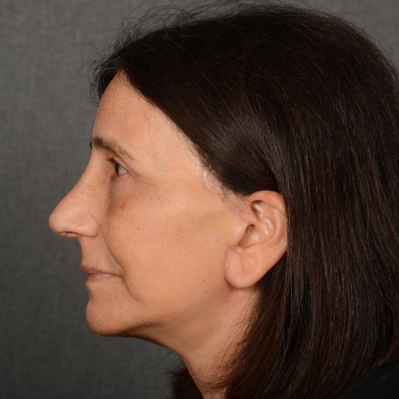 Facelift Before & After Gallery - Patient 682688 - Image 6