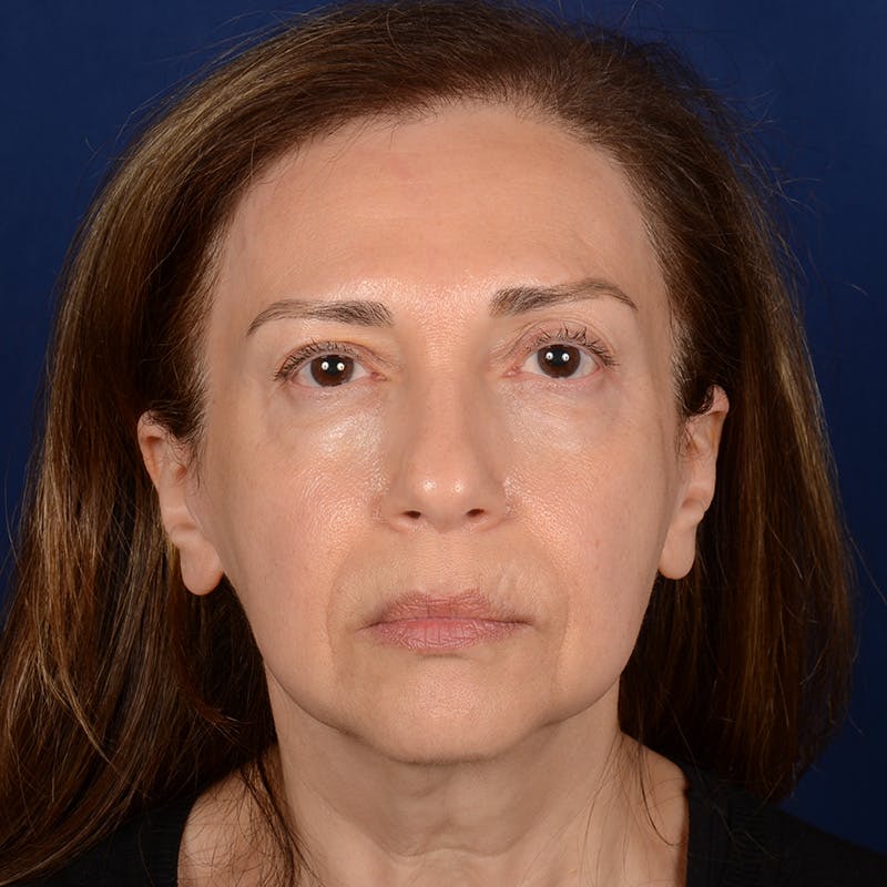 Facelift Before & After Gallery - Patient 579527 - Image 1