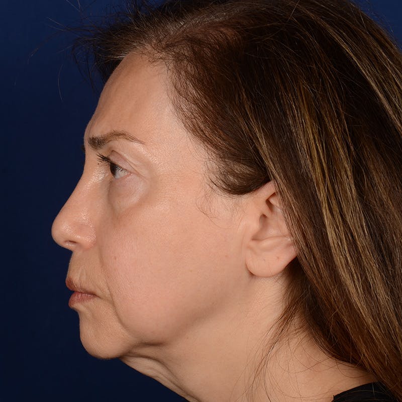 Facelift Before & After Gallery - Patient 579527 - Image 5