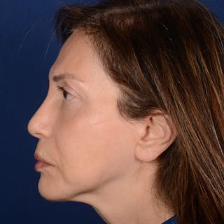 Facelift Before & After Gallery - Patient 579527 - Image 6