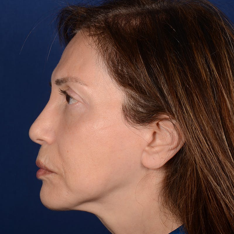 Facelift Before & After Gallery - Patient 579527 - Image 6