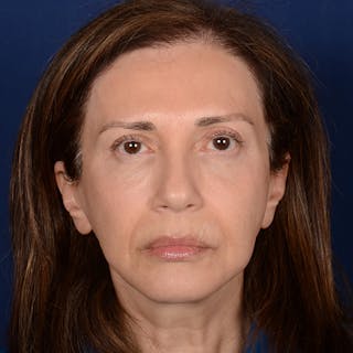 Facelift Before & After Gallery - Patient 579527 - Image 2