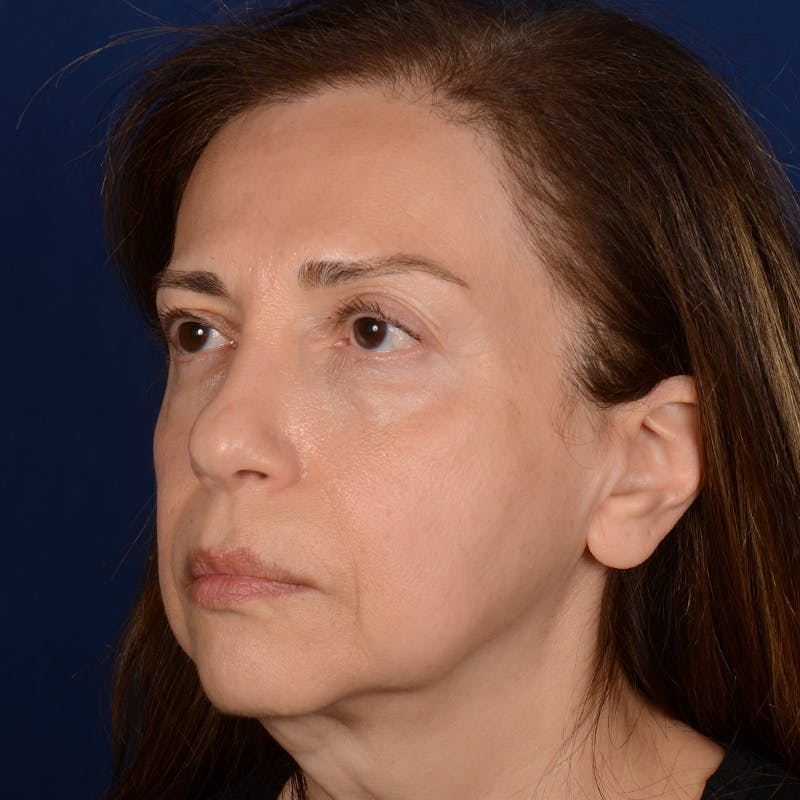 Facelift Before & After Gallery - Patient 579527 - Image 3