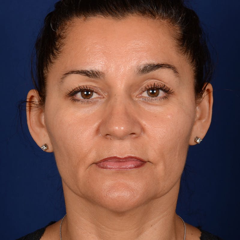 Facelift Before & After Gallery - Patient 157181 - Image 1
