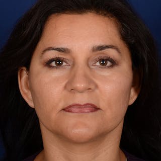 Facelift Before & After Gallery - Patient 157181 - Image 2