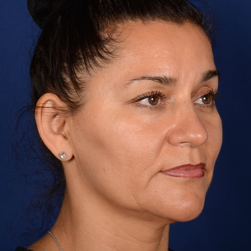 Facelift Before & After Gallery - Patient 157181 - Image 3