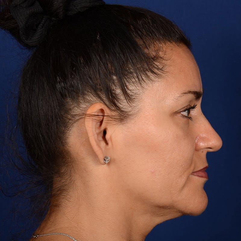 Facelift Before & After Gallery - Patient 157181 - Image 5