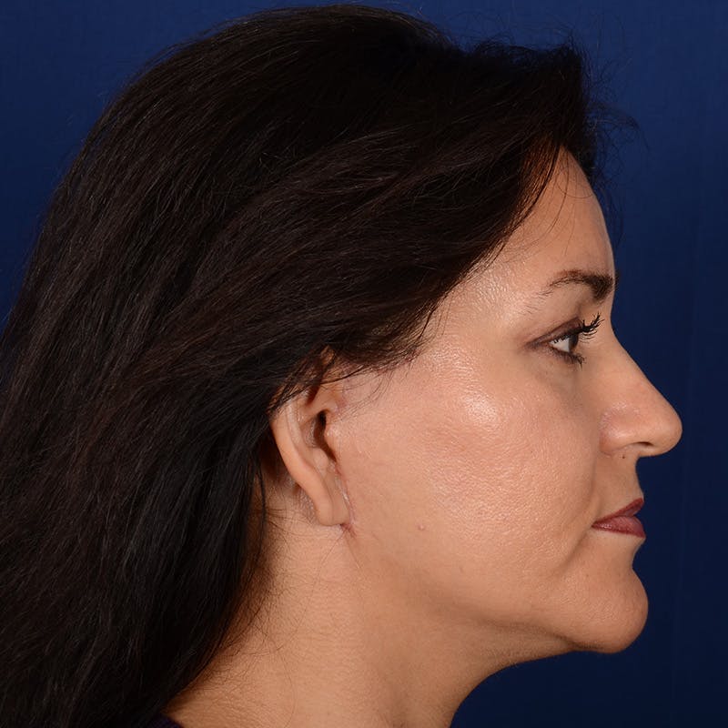 Facelift Before & After Gallery - Patient 157181 - Image 6