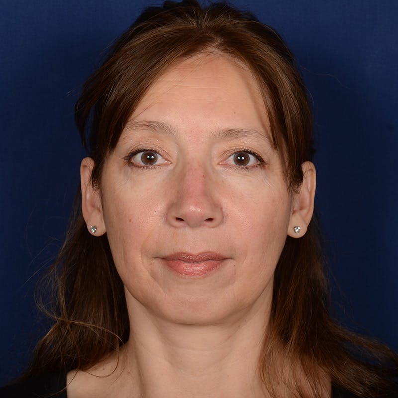 Corrective / Revision Rhinoplasty Before & After Gallery - Patient 420076 - Image 1