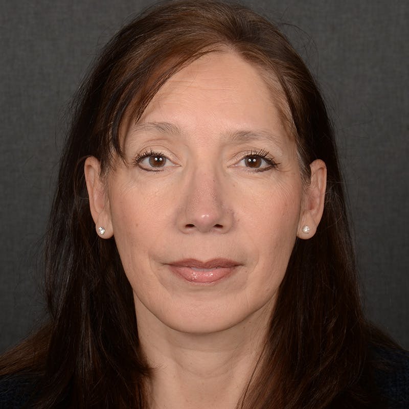 Corrective / Revision Rhinoplasty Before & After Gallery - Patient 420076 - Image 2