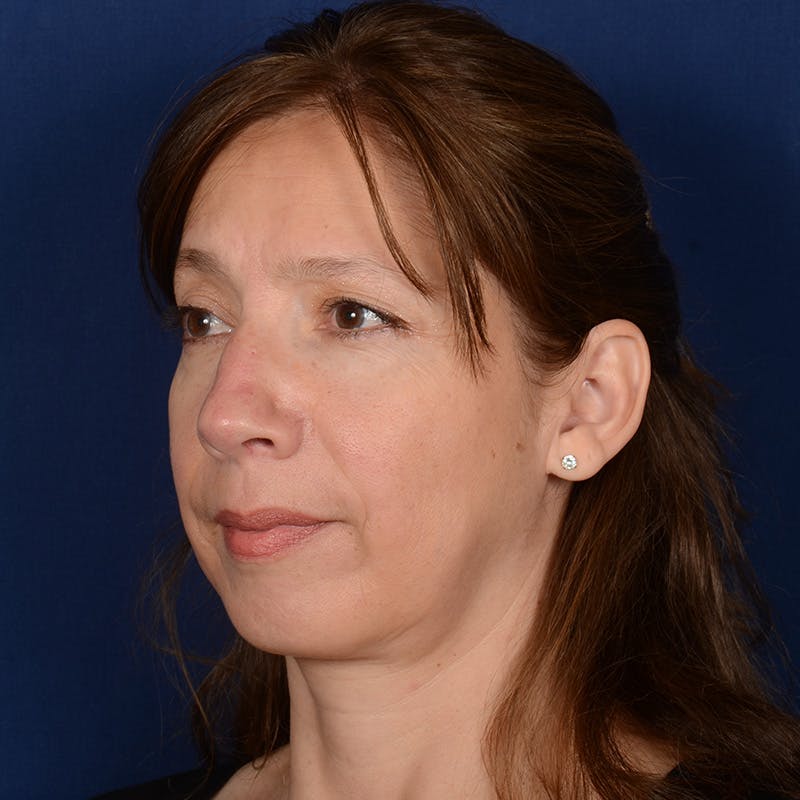 Corrective / Revision Rhinoplasty Before & After Gallery - Patient 420076 - Image 3