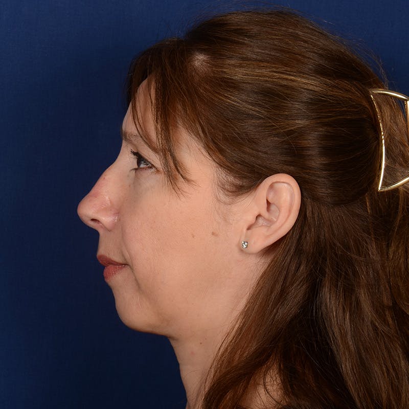 Corrective / Revision Rhinoplasty Before & After Gallery - Patient 420076 - Image 5