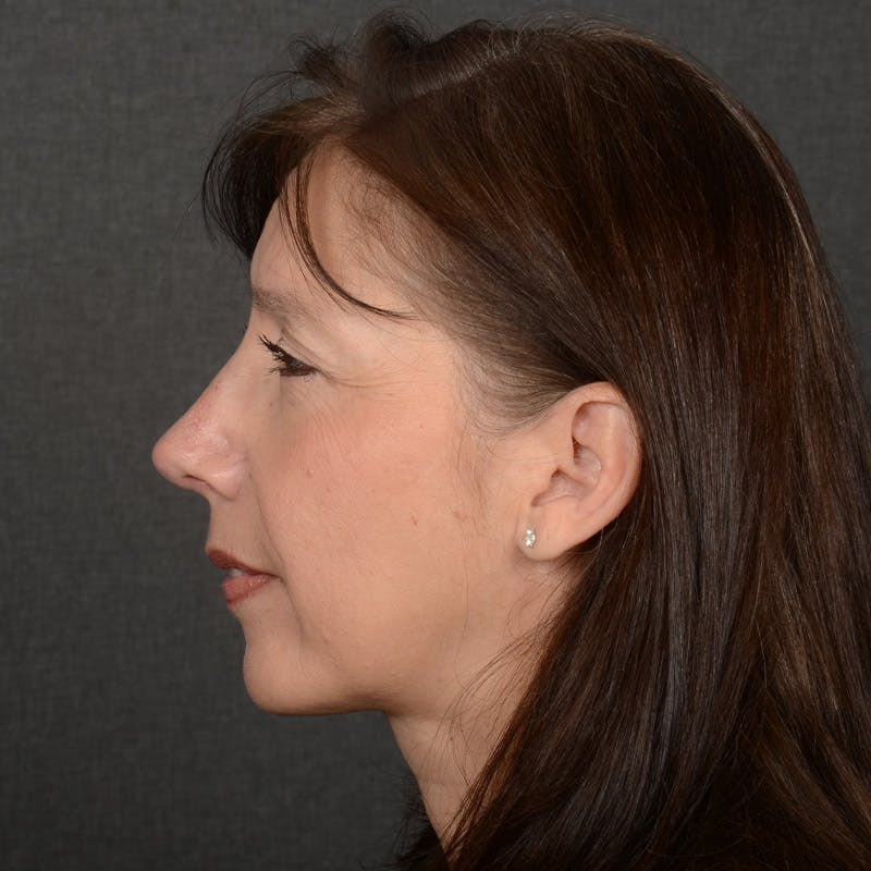 Corrective / Revision Rhinoplasty Before & After Gallery - Patient 420076 - Image 6