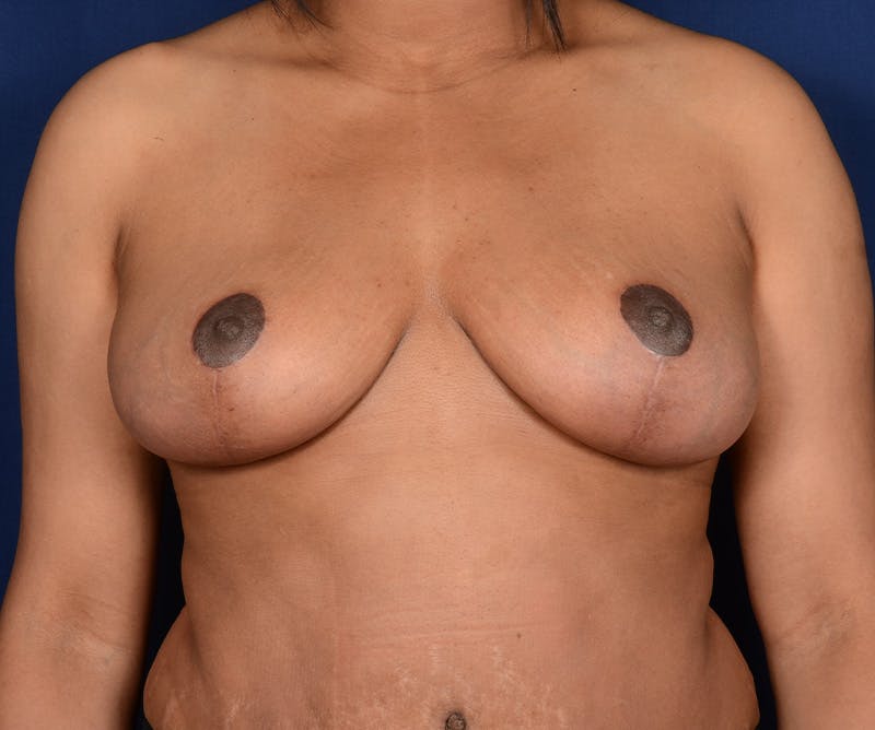 Breast Reduction Before & After Gallery - Patient 326396 - Image 2