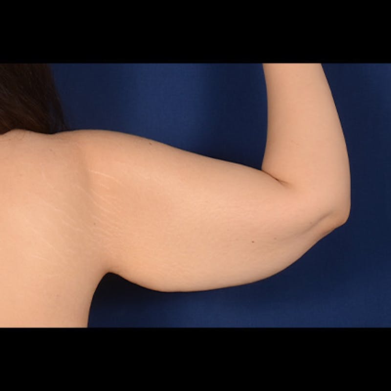 Arm Lift Before & After Gallery - Patient 156481 - Image 3