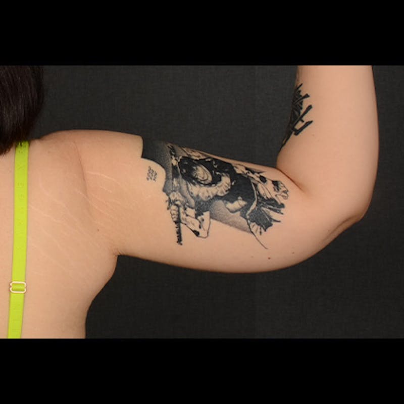 Arm Lift Before & After Gallery - Patient 156481 - Image 4