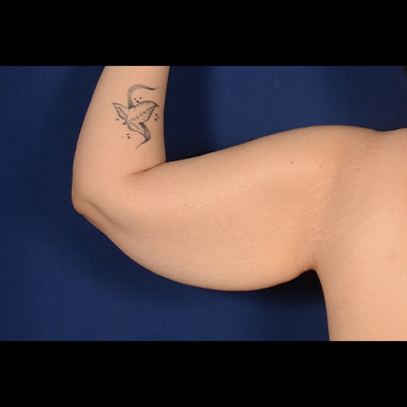 Arm Lift Before & After Gallery - Patient 156481 - Image 5