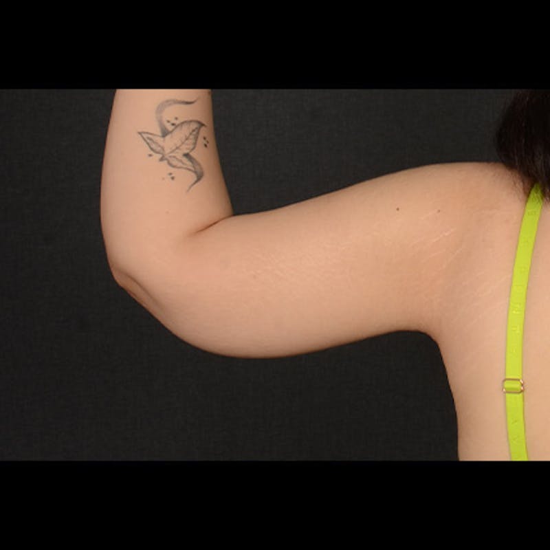 Arm Lift Before & After Gallery - Patient 156481 - Image 6