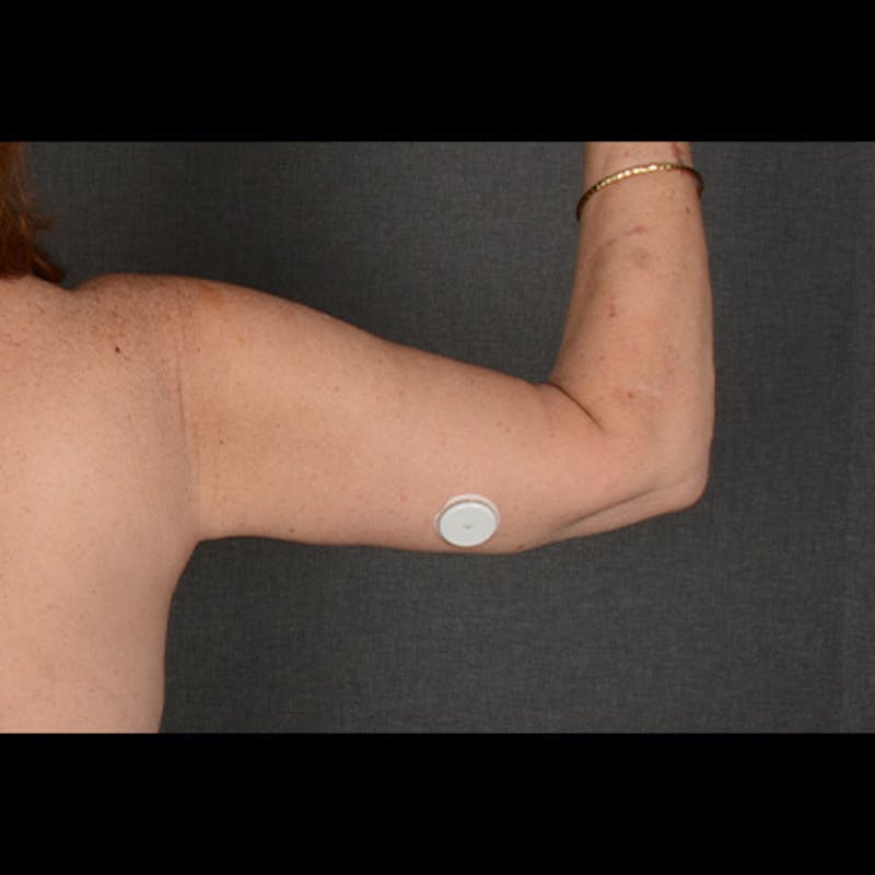 Arm Lift Before & After Gallery - Patient 102251 - Image 4