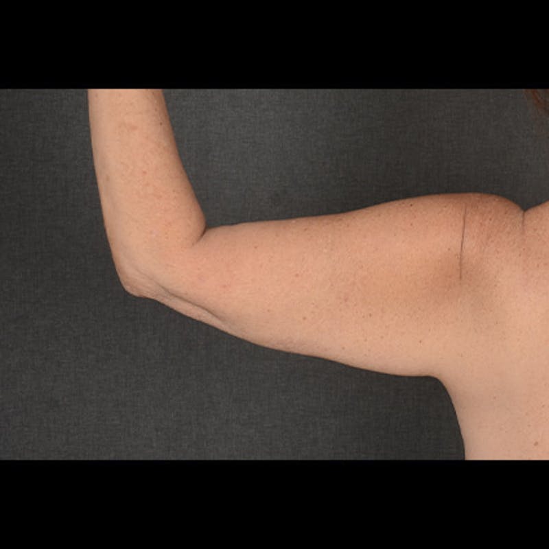Arm Lift Before & After Gallery - Patient 102251 - Image 5