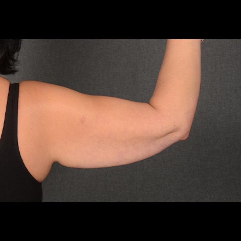 Arm Lift Before & After Gallery - Patient 383999 - Image 3