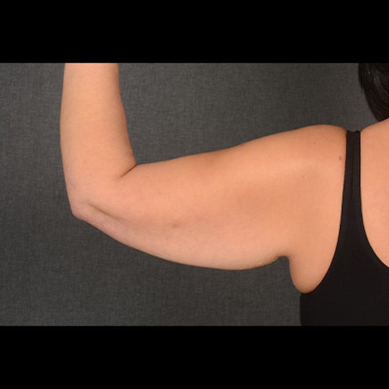 Arm Lift Before & After Gallery - Patient 383999 - Image 5