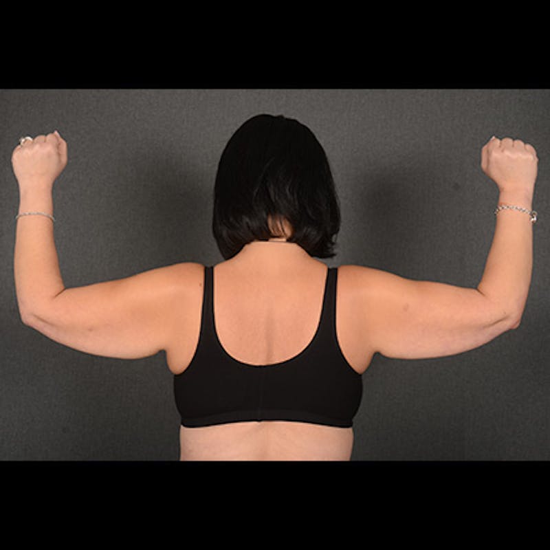 Arm Lift Before & After Gallery - Patient 383999 - Image 1