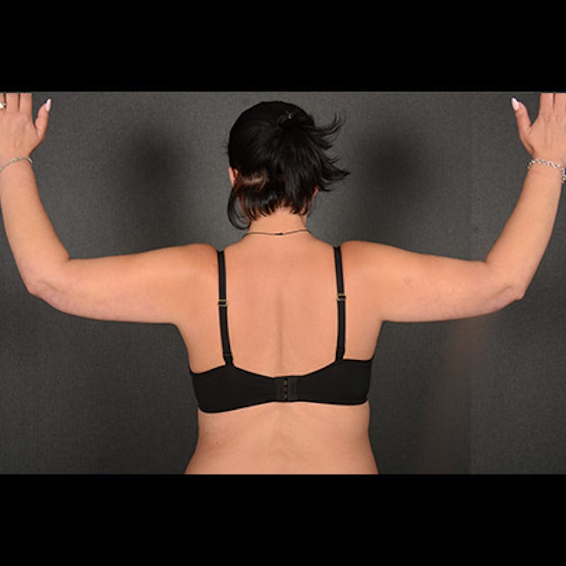 Arm Lift Before & After Gallery - Patient 383999 - Image 2