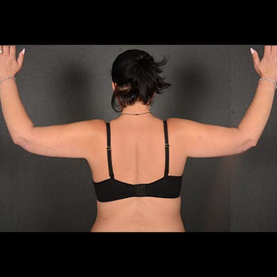 Arm Lift Before & After Gallery - Patient 383999 - Image 2
